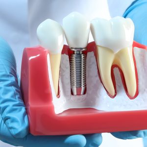What Happens While Getting A Dental Implants?