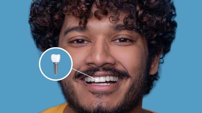 Dental Implants in Murfreesboro: Costs, Benefits, and Recovery Tips