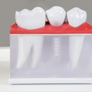 Why More Cedar Park Residents Are Choosing Dental Implants Over Dentures