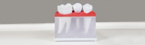 Cedar Park Dental Implants, Dental Implants near me