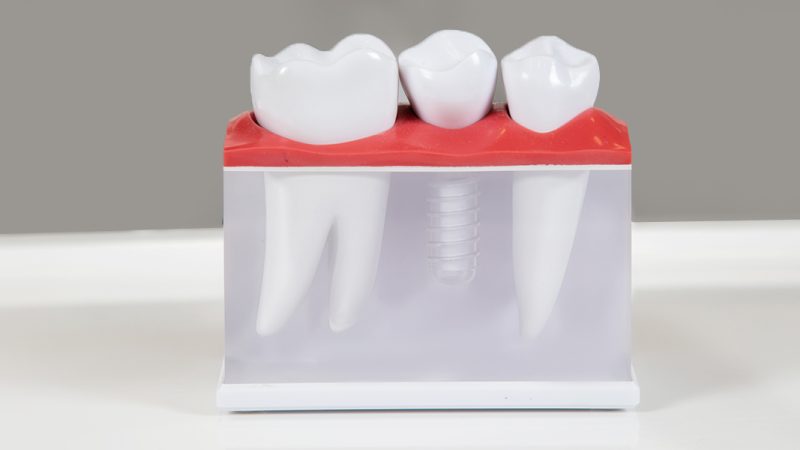 Why More Cedar Park Residents Are Choosing Dental Implants Over Dentures