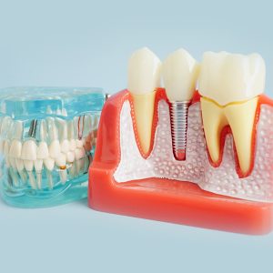 Thinking About Dental Implants in Paoli, PA? Read This First!