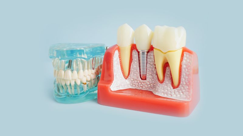 Thinking About Dental Implants in Paoli, PA? Read This First!