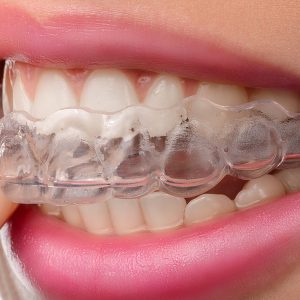 Can Invisalign Fix Severe Alignment Issues?