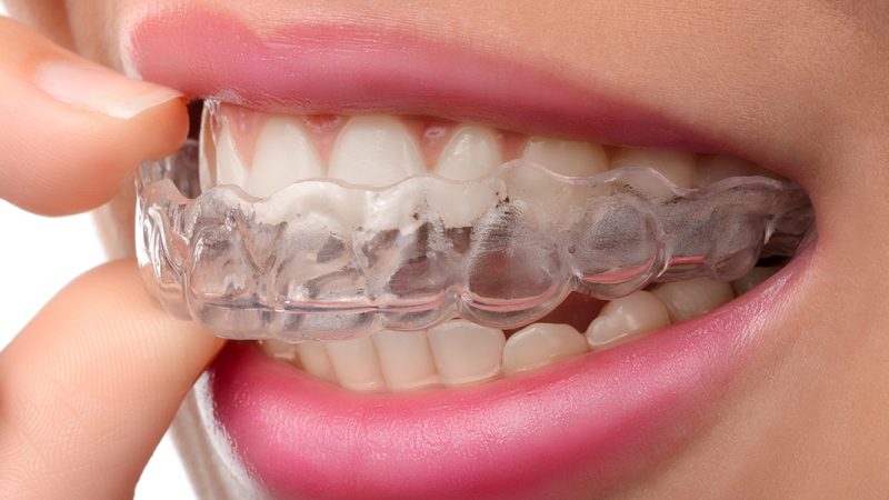 Can Invisalign Fix Severe Alignment Issues?