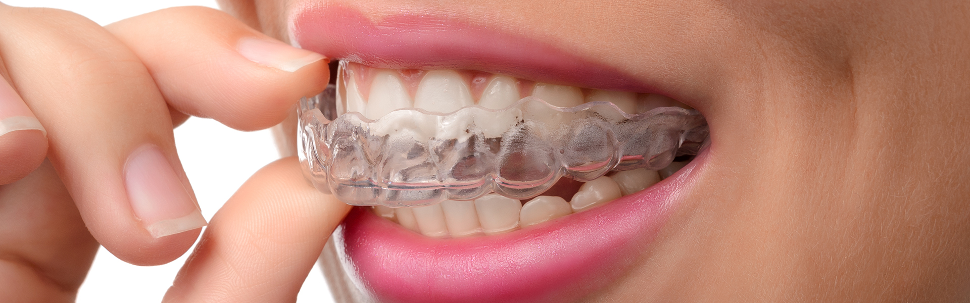Can Invisalign Fix Severe Alignment Issues?